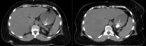 CT Abnormality in Patient With Stage II Breast Cancer History