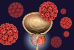 High ORR Associated With Enfortumab Vedotin Plus Pembrolizumab in Metastatic Urothelial Cancer