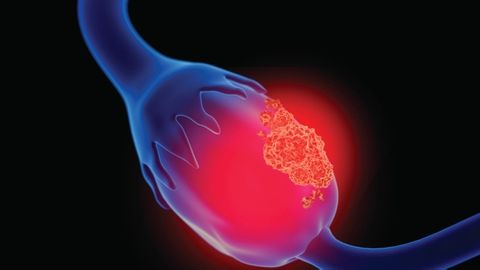 Ovarian Cancer | Cancer Network
