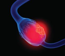 OS Not Improved, Modest PFS Benefit Noted Following Chemo Maintenance in Newly Diagnosed Advanced Ovarian Cancer