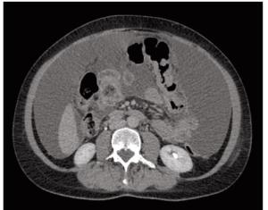 Approaching Use of CDK4/6 Inhibitors in Metastatic HR+, HER2- Breast Cancer