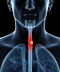 In patients less likely to respond to neoadjuvant chemoradiation, postoperative adjuvant therapy may be a viable strategy in this ESCC group.