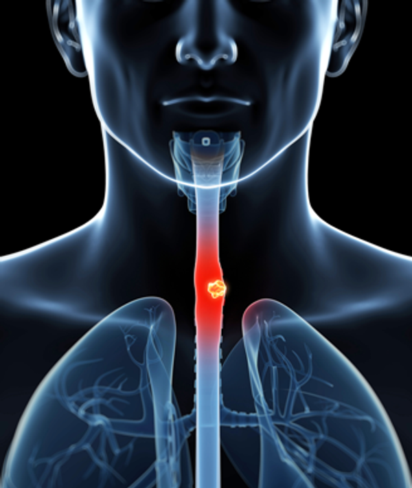 In patients less likely to respond to neoadjuvant chemoradiation, postoperative adjuvant therapy may be a viable strategy in this ESCC group.