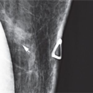 Don’t Be Fooled by DCIS 