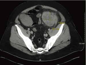 Complete Pathologic Response to Neoadjuvant Chemoimmunotherapy and Oxaliplatin-Induced Fever Associated With IL-6 Release in a Patient With Locally Advanced Colon Cancer