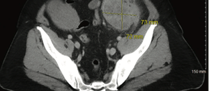 Complete Pathologic Response to Neoadjuvant Chemoimmunotherapy and Oxaliplatin-Induced Fever Associated With IL-6 Release in a Patient With Locally Advanced Colon Cancer