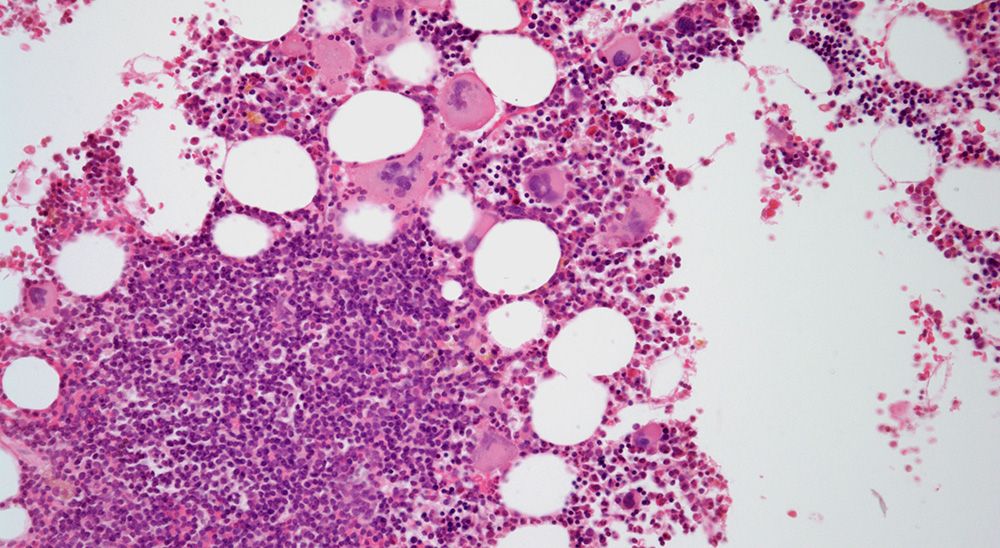 Results from the phase 3 MOMENTUM trial led momelotinib to being approved by the European Commission for patients with myelofibrosis plus anemia and splenomegaly. 