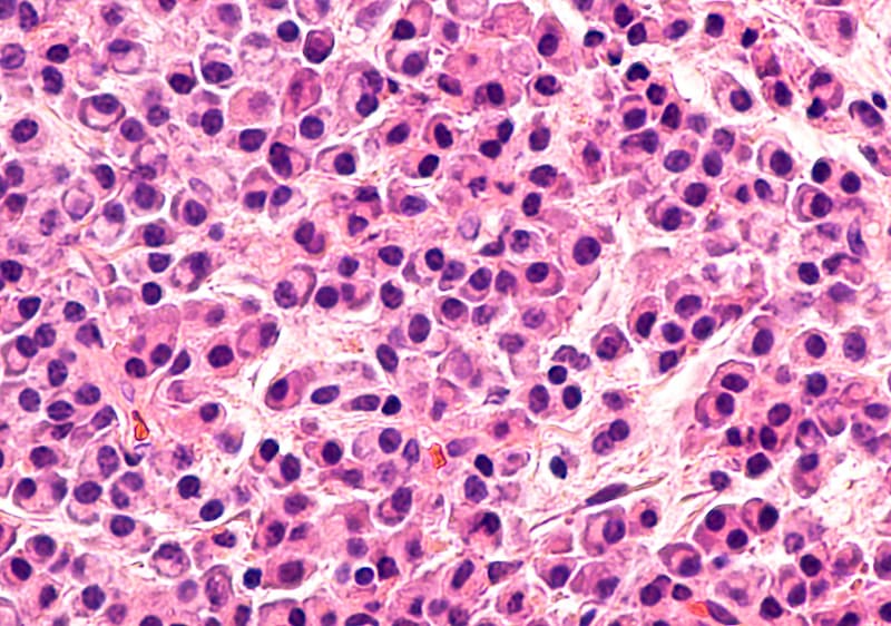 Findings from the phase 1b/2 NEXICART-1 study indicated that NXC-201 produced complete responses in 6 evaluable patients with relapsed or refractory AL amyloidosis.