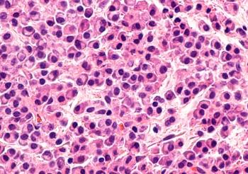 Findings from the phase 1b/2 NEXICART-1 study indicated that NXC-201 produced complete responses in 6 evaluable patients with relapsed or refractory AL amyloidosis.