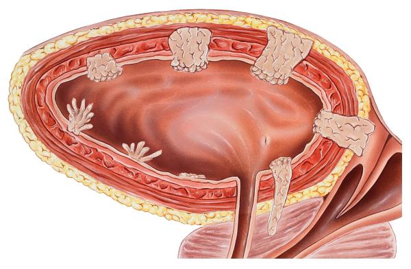 The investigational BCG-containing regimen conferred a weighted anytime CR rate of 69.7% vs 53.4% with nadofaragene firadenovec in this NMIBC group.