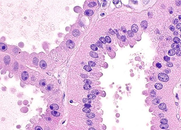 Mucinous Rcc Slide Show: Renal Cell Carcinoma