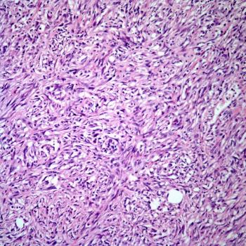 Santosh Rao, MD, discusses ongoing and potential future research efforts aiming to maximize the benefits that patients with kidney cancer may derive from integrative oncology treatment techniques.