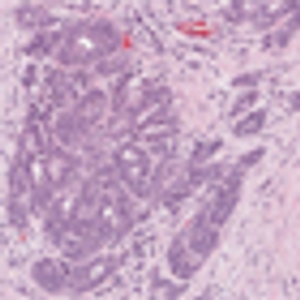Core Biopsy of Prostate From an Elderly Male