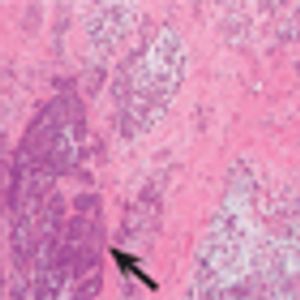 Metaplastic Mammary Carcinoma With Discrepant Hormone Receptor Results by IHC and RT-PCR