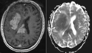Facial Drooping and Weakness in 74-Year-Old Patient