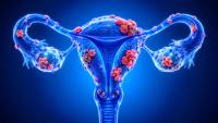 The Usefulness of Indocyanine Green in Cytoreductive Ovarian Cancer Surgery: © Kathy Mathews - stock.adobe.com