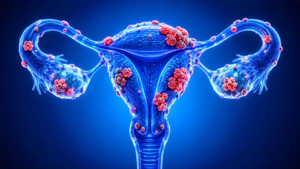 The Usefulness of Indocyanine Green in Cytoreductive Ovarian Cancer Surgery: © Kathy Mathews - stock.adobe.com