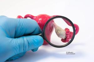 ovarian cancer, ovary, gynecology, fallopian tube