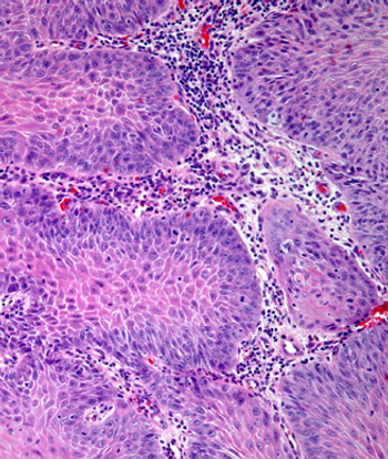 Camrelizumab plus apatinib demonstrate impressive anti-tumor activity in a pretreated population with recurrent or metastatic nasopharyngeal carcinoma, although further research is needed, according to an expert from Memorial Sloan Kettering Cancer Center.