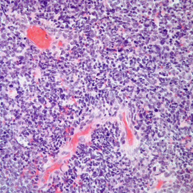 Treatment with dostarlimab plus chemotherapy followed by dostarlimab appears to improve outcomes among patients with advanced endometrial cancer and mismatch repair deficient disease in the phase 3 RUBY trial.