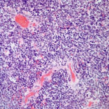 Treatment with dostarlimab plus chemotherapy followed by dostarlimab appears to improve outcomes among patients with advanced endometrial cancer and mismatch repair deficient disease in the phase 3 RUBY trial.