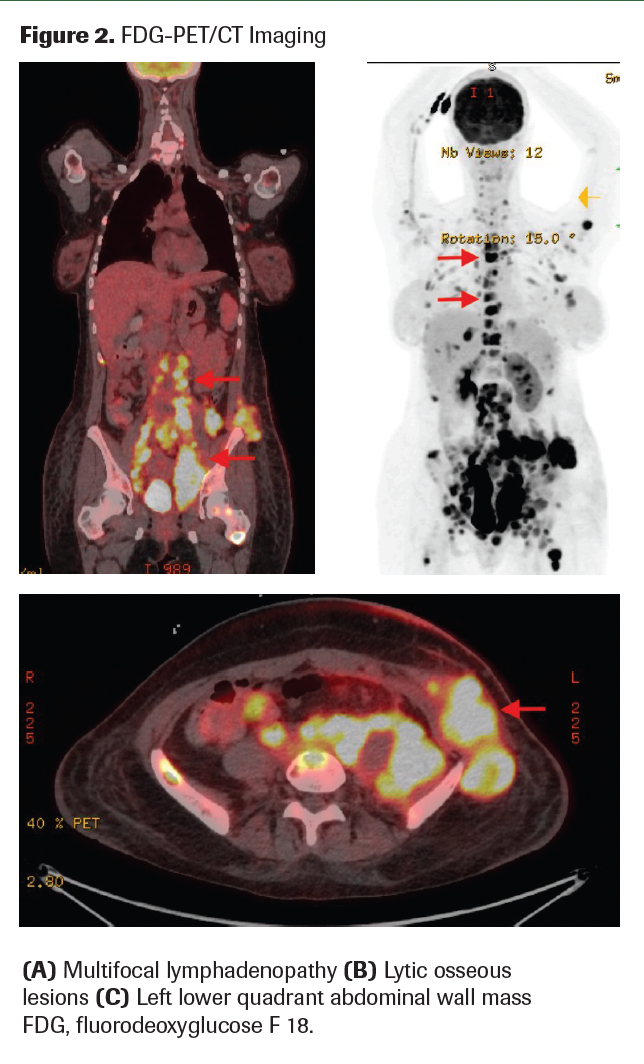melanotic sarcoma Unusual Clinical Presentation of Clear Cell Sarcoma in a Young Woman