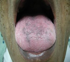 68-Year-Old Woman With a History of Aggressive NHL Presents With Tongue Hyperpigmentation