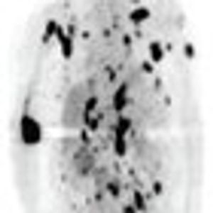 Cancer Metabolism as a Therapeutic Target
