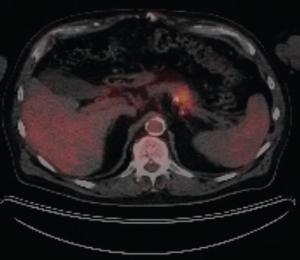 Hereditary vs Familial Pancreatic Cancer: Associated Genetic Syndromes and Clinical Perspective
