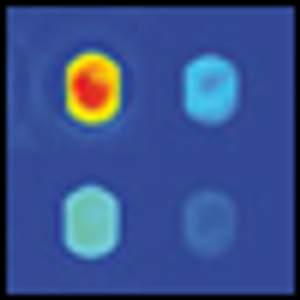 Current Management of Primary Cutaneous CD30+ T-cell Lymphoproliferative Disorders