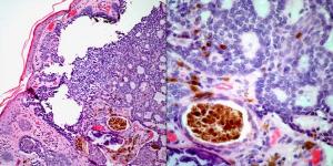 Lightly Pigmented Skin Lesion on 35-Year-Old Patient