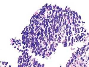 Synchronous Bilateral Lung Cancer With Discordant Histology