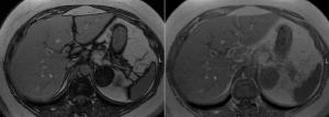 Adrenal Lesion Discovered in 50-Year-Old Patient