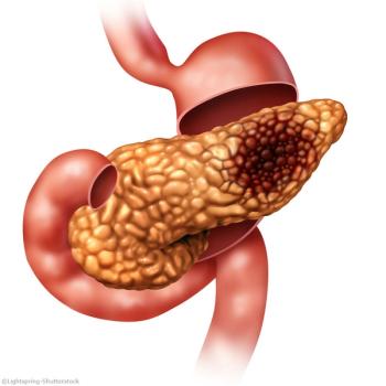 The FDA decision follows phase 2 CANFOUR trial data showing a 2-year survival rate of 35% in IL1RAP-high metastatic pancreatic ductal adenocarcinoma.