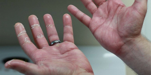 Rectal Cancer Patient Presents With Hand Edema and Erythema