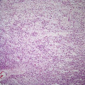 Common treatment-emergent adverse effects among patients receiving PRT811 for uveal melanoma or advanced glioma include nausea and vomiting in a phase 1 study.