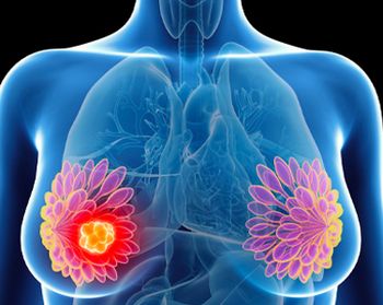 The pembrolizumab-based regimen in the phase 3 KEYNOTE-756 trial produces a larger pathologic complete response benefit in patients with node-positive disease and higher PD-L1 expression, according to Joyce O’Shaughnessy, MD.