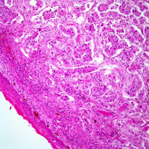 Data from the INTERLACE trial support induction chemotherapy prior to chemoradiation as a potential standard in locally advanced cervical cancer.