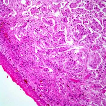 Data from the INTERLACE trial support induction chemotherapy prior to chemoradiation as a potential standard in locally advanced cervical cancer.