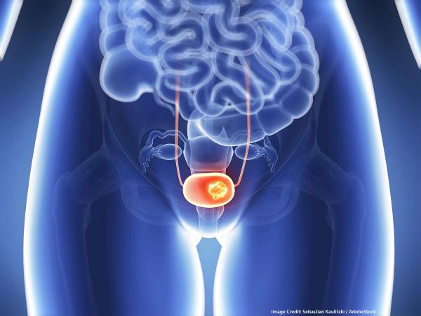 Results from the phase 3 VOLGA trial demonstrate that perioperative durvalumab plus neoadjuvant enfortumab vedotin significantly improved EFS and OS in MIBC.