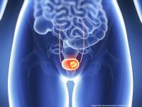 Results from the phase 3 VOLGA trial demonstrate that perioperative durvalumab plus neoadjuvant enfortumab vedotin significantly improved EFS and OS in MIBC.