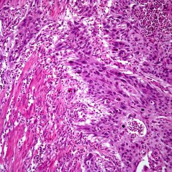 Interim findings from a phase 3 trial support adjuvant pembrolizumab as a new therapeutic option for those with muscle-invasive urothelial carcinoma at high risk of recurrence.