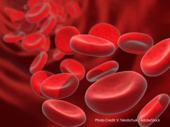 The addition of comprehensive bridging radiotherapy to extramedullary disease sites before CAR T therapy may improve PFS outcomes in multiple myeloma.