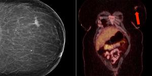 Breast Lesion in Patient With HIV