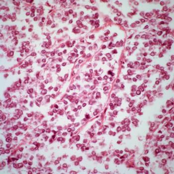 Brian Van Tine, MD, PhD, discusses clinical trials assessing several regimens that may lead to novel treatment options for those with desmoid tumors, dedifferentiated liposarcoma, and other hard-to-treat sarcoma subtypes.