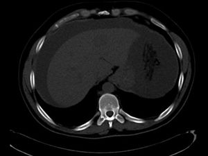 Patient With Abdominal Inflammatory Myofibroblastic Tumor