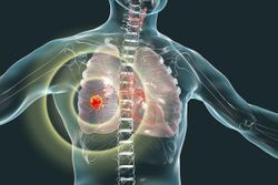 European Commission Approves Capmatinib in NSCLC With MET Exon 14 Skipping Mutation 