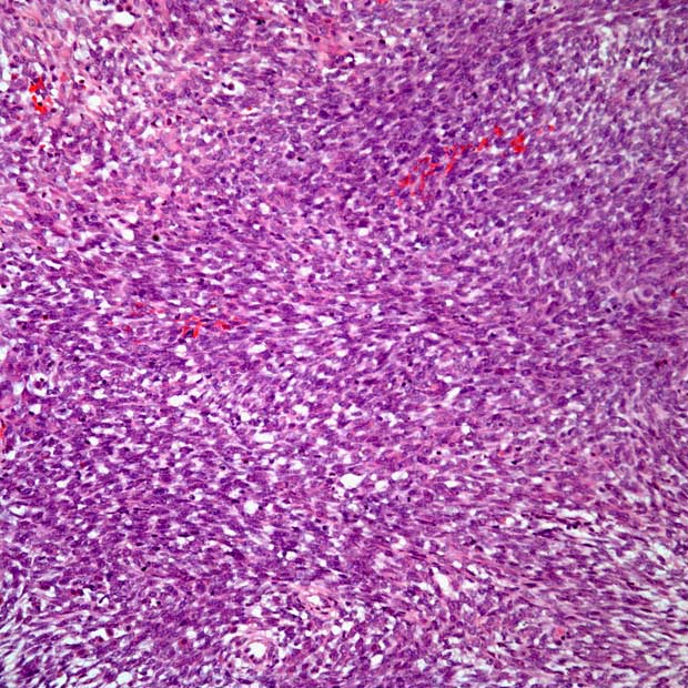 Tisotumab Vedotin Improves Survival Vs Chemo In Recurrent Cervical Cancer   F09342d4a81218264b0b43eb2d329fcabeac2cd0 620x620 