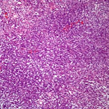 The safety profile of tisotumab vedotin-tftv among those with recurrent or metastatic cervical cancer in the phase 3 innovaTV 301 trial appears to be comparable with prior reports of the agent.