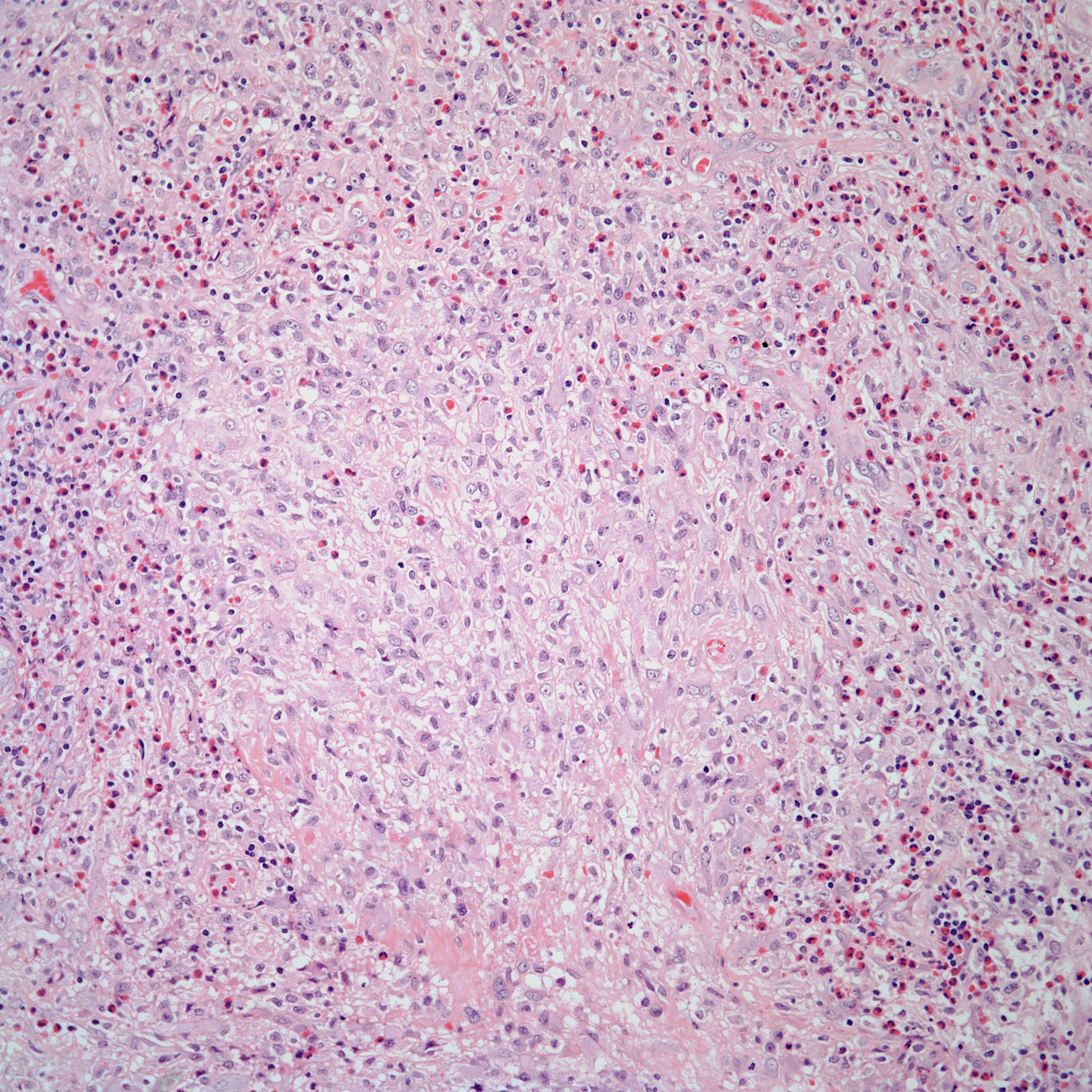 Breast Induration in a 36-Year-Old Woman With Hx of Implants